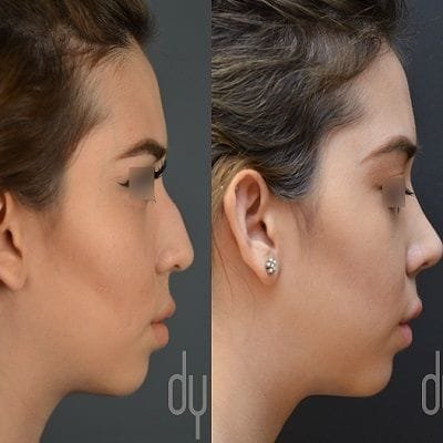 Nose Surgery With Hollywood Surgeon in Dubai