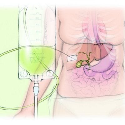 Percutaneous Cystostomy in Dubai & Abu Dhabi