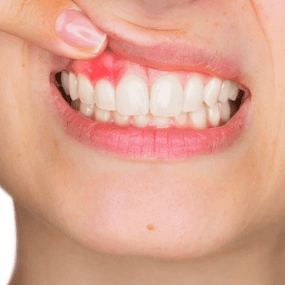 Periodontics & Gum Disease in Dubai