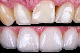 Porcelain Dental Veneers Dubai