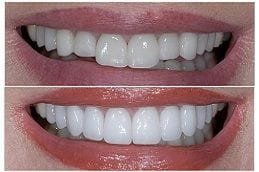 Porcelain Dental Veneers in Dubai, Abu Dhabi & Sharjah