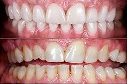 Porcelain Dental Veneers in Dubai