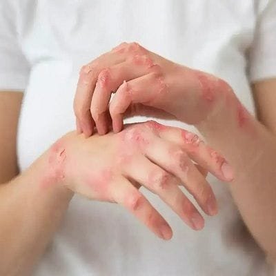 Precision Dermatology: Skin Diseases Treatment