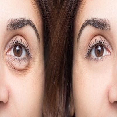 PRP For Dark Circles