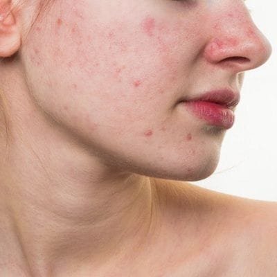 Red Acne Scar Treatment
