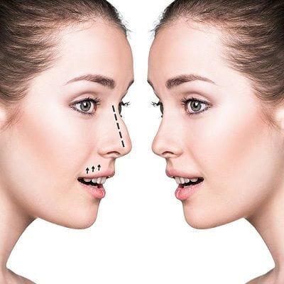 Rhinoplasty Cost for Broken Nose