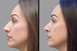 Rhinoplasty Dubai Silicon Oasis Before & After