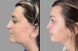 Rhinoplasty in Dubai Silicon Oasis Before & After