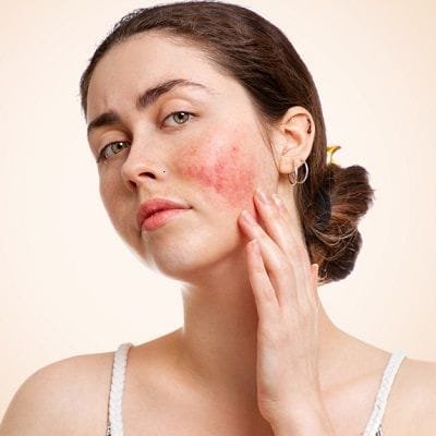 Rosacea Treatment for Face in Dubai