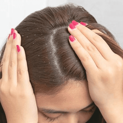Scalp Fungus And Hair Loss Treatment in Dubai