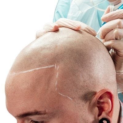 Scalp Micropigmentation in Dubai