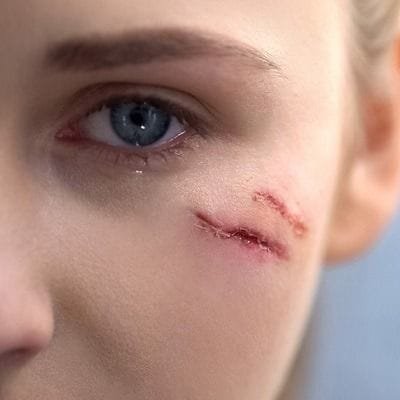 Scar Solutions: Breaking Down Hypertrophic Scars in Dubai
