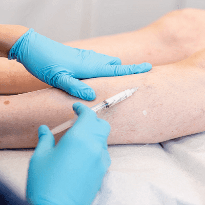 Sclerotherapy Cost in Dubai