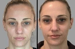 Sculptra Fillers Before After
