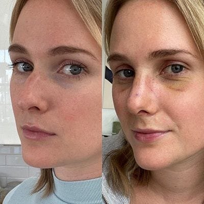 Turbinate Reduction & Septoplasty in Dubai