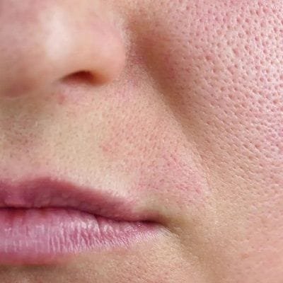 Shrink Enlarged Pores with HALO Treatment