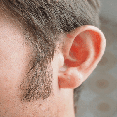 Sideburn Hair Transplant in Dubai