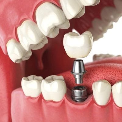 Single Tooth Implant Cost