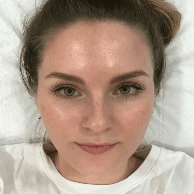 Smooth and Soothe: Facial Capillaries Treatment in Dubai