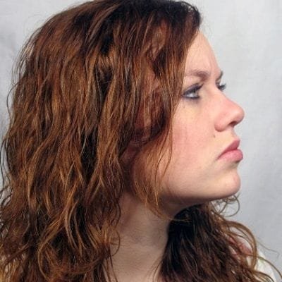 Stem Cell Therapy for Hair Loss Treatment
