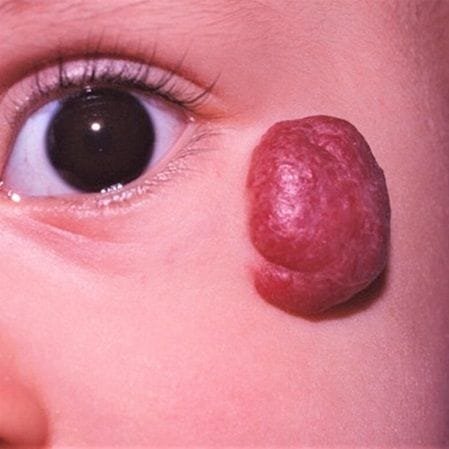 Strawberry Hemangioma Treatment for Baby
