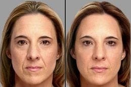 Sunekos Injection Before After