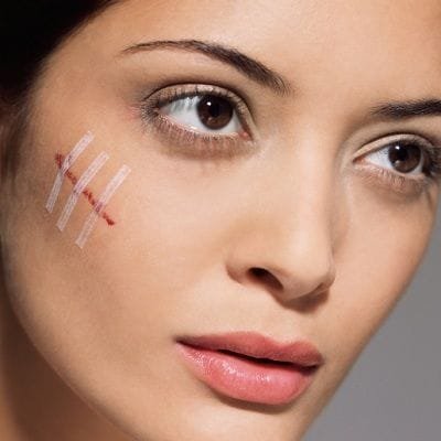 Surgical Scar Revision Cost In Dubai