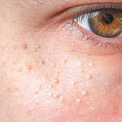 Syringoma Treatment Cost in Dubai