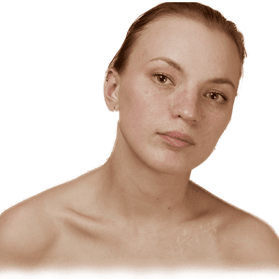 Techniques to Treat Scars with Dermal Pigmentation in Dubai