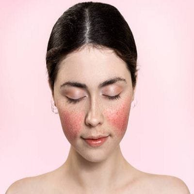Understanding the 4 Types and Rosacea Treatment Options