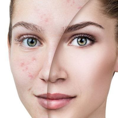 The Best Facials for Scars & Hyperpigmentation in Dubai