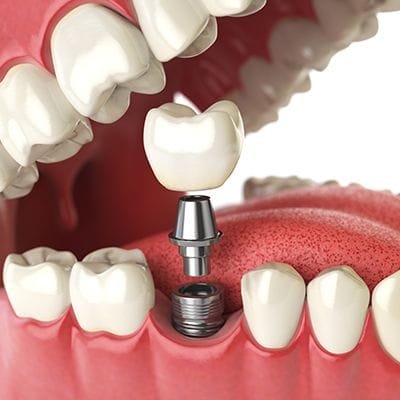 Titanium Dental Implant Cost in Dubai