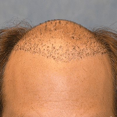 Transform Your Look With Hair Implants in Dubai