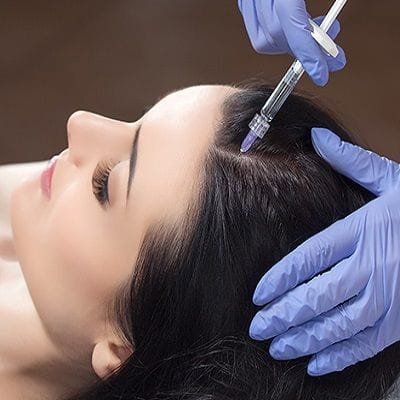 Treatment of Alopecia Areata by Prp Therapy