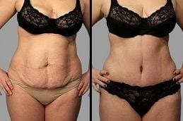 Tummy Tuck | Abdominoplasty 4 Tummy Tuck Before & After
