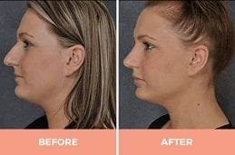Ultrasonic Rhinoplasty Treatment Dubai & Abu Dhabi