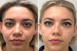 Under Eye Fillers 6 Under Eye Fillers Before and After