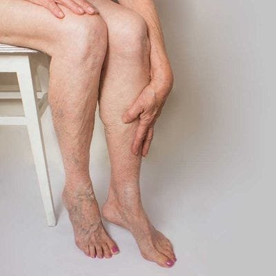 Varicose Veins Treatment Cost Dubai