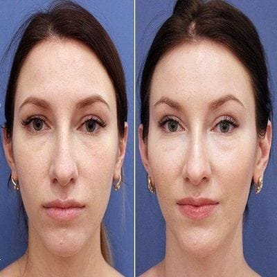 What Can Fat Injections Do For the Aging Face