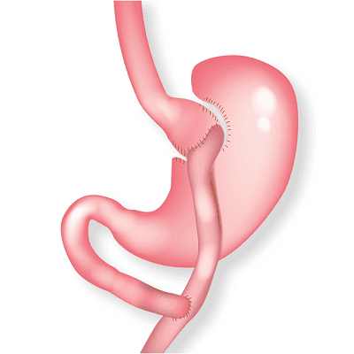 What Does Gastric Bypass Surgery Do