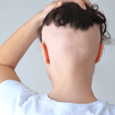 What Is Frontal Fibrosing Alopecia In Dubai?