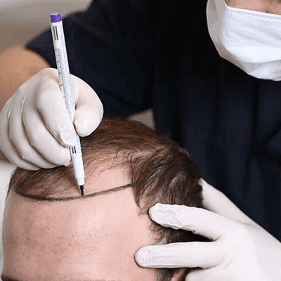 What Is Hairline Lowering Surgery in Dubai