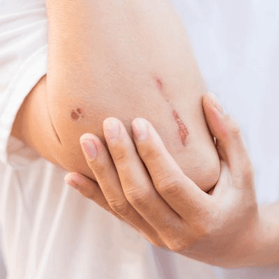 What Kinds of Scars can be Camouflaged