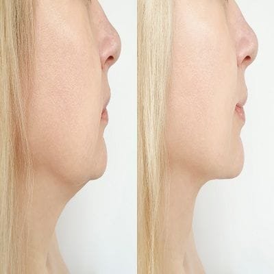What do you know about Belkyra Treatment