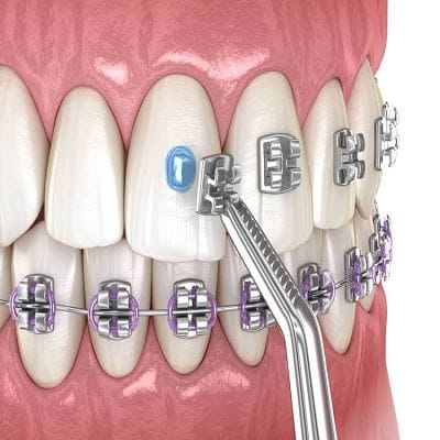 Which Type Of Braces Are The Best