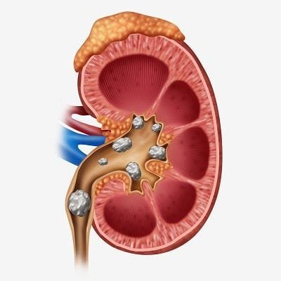 Why is Kidney Stone Removal Necessary in Dubai?