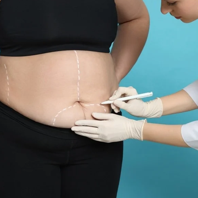 Will I Look Older After Bariatric Surgery?