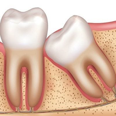 Wisdom Teeth - Infection & Extraction