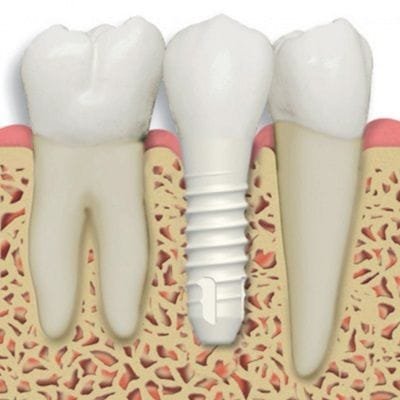 Zirconia Dental Implant in Dubai & Abu Dhabi Cost