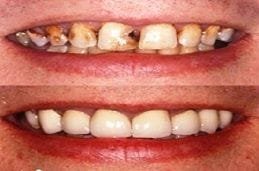 Full Mouth Dental Implants Cost 8 best-dental-implants-clinic-in-uae